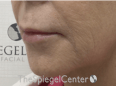 Lip Lift Before & After Gallery - Patient 157140015 - Image 3