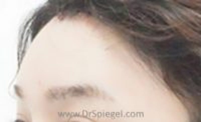 Browlift / Fox Eye Lift Before & After Gallery - Patient 157140014 - Image 2