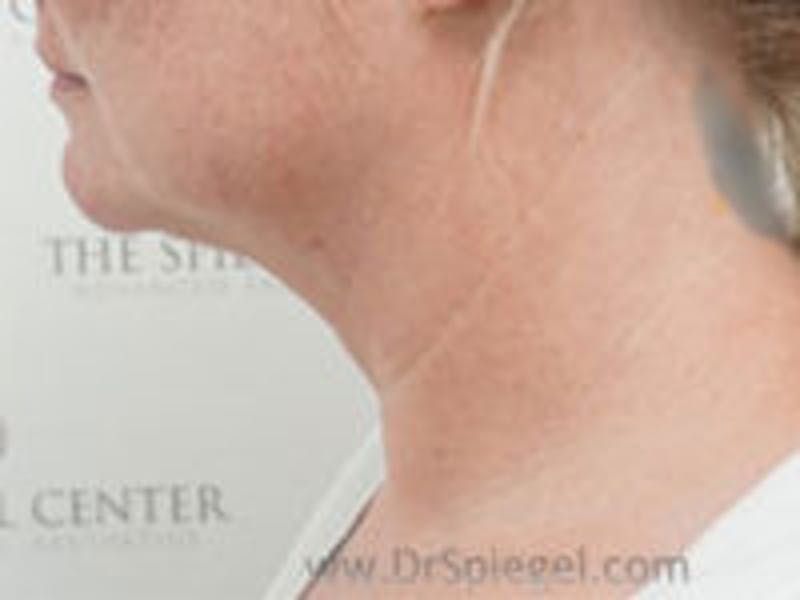 Neck Lift Before & After Gallery - Patient 157140017 - Image 1