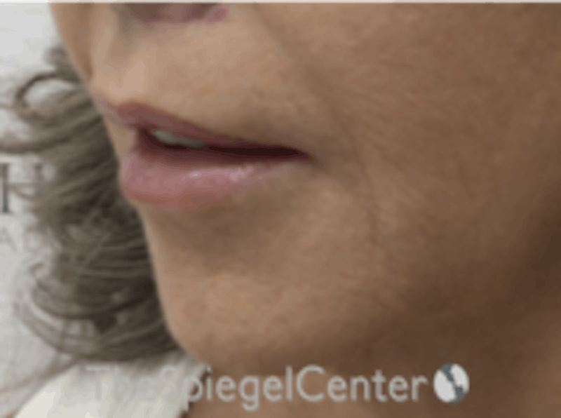Lip Augmentation / Lip Implant / Lip Lift Before & After Gallery - Patient 157140015 - Image 4