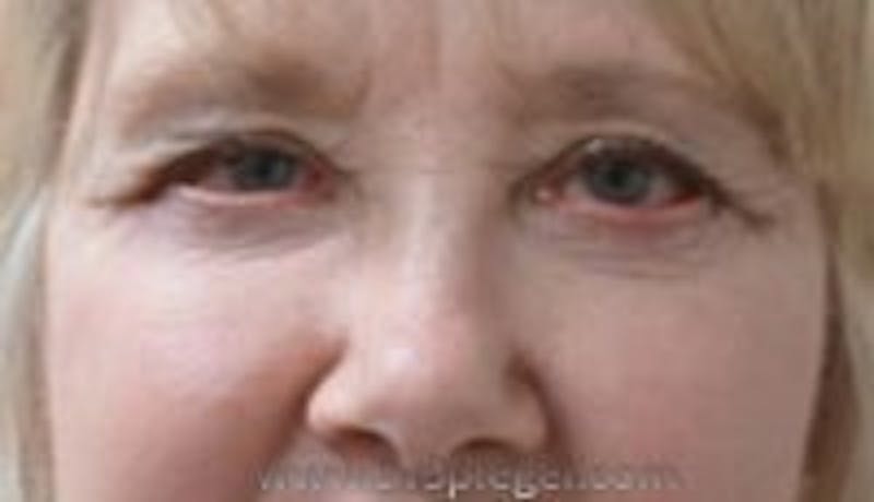 Blepharoplasty Before & After Gallery - Patient 157140018 - Image 1