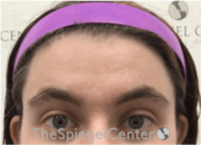 Forehead Contouring Before & After Gallery - Patient 157140024 - Image 1