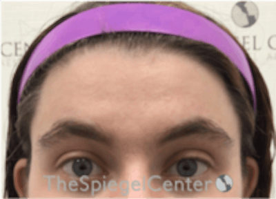 Forehead Contouring Before & After Gallery - Patient 157140024 - Image 1