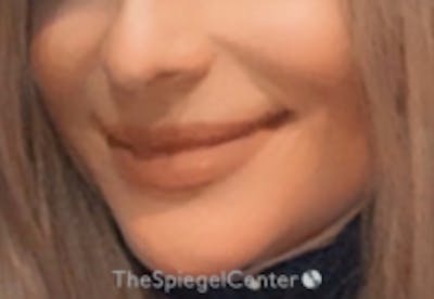 Mandible Contouring Before & After Gallery - Patient 157140016 - Image 2