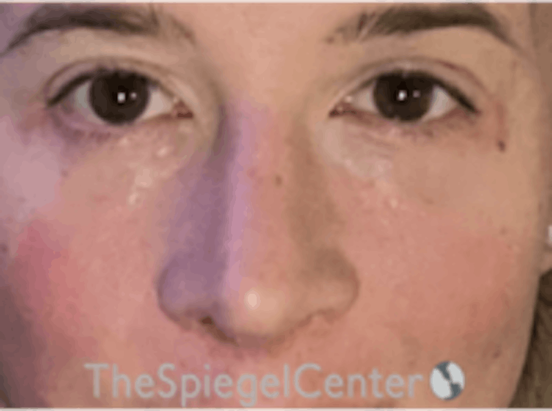 Rhinoplasty Before & After Gallery - Patient 288512 - Image 4
