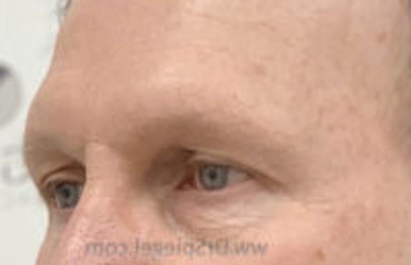 Browlift / Fox Eye Lift Before & After Gallery - Patient 157140021 - Image 1