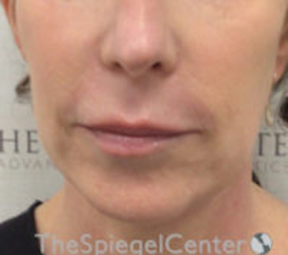 Lip Lift / Augmentation