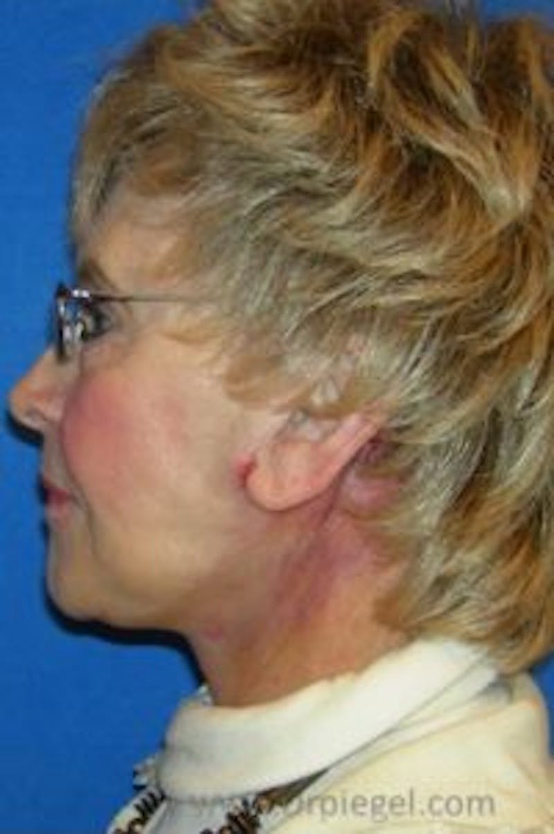 Facelift Before & After Gallery - Patient 157140020 - Image 2