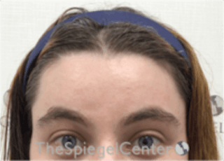 Forehead Contouring Before & After Gallery - Patient 157140024 - Image 2