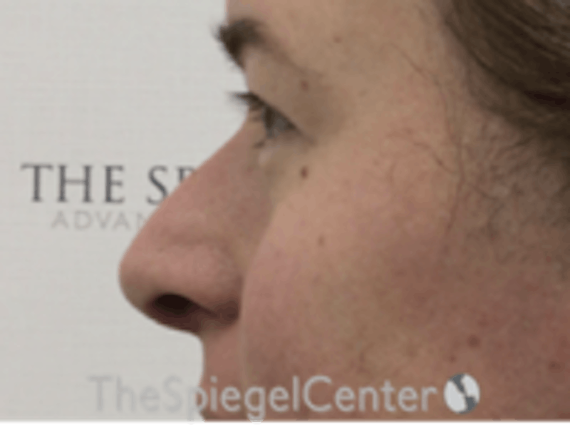 Rhinoplasty Before & After Gallery - Patient 157140022 - Image 1