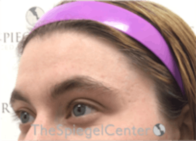 Forehead Contouring Before & After Gallery - Patient 157140024 - Image 3