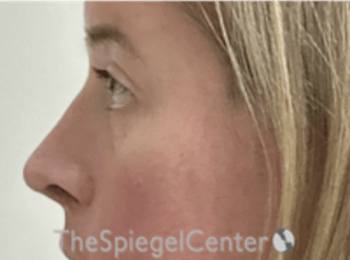 Rhinoplasty Before & After Gallery - Patient 288512 - Image 2