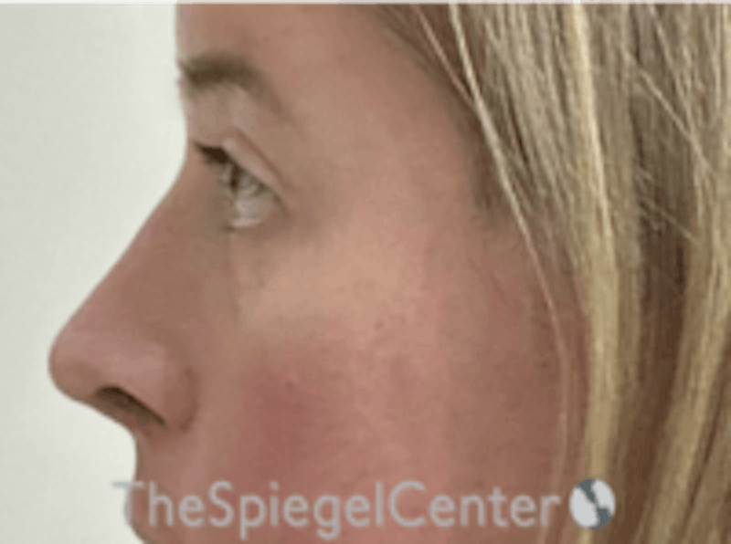 Rhinoplasty Before & After Gallery - Patient 157140022 - Image 2