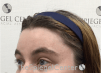 Forehead Contouring Before & After Gallery - Patient 157140024 - Image 4