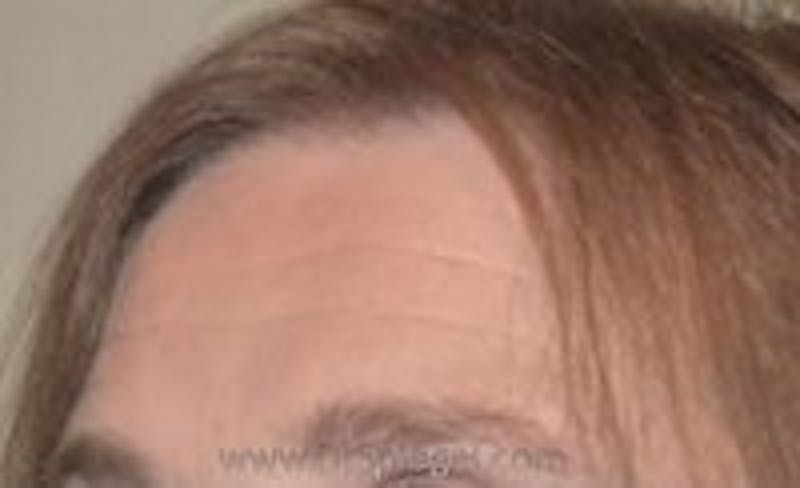Browlift / Fox Eye Lift Before & After Gallery - Patient 157140027 - Image 1
