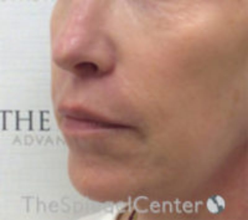Lip Augmentation / Lip Implant / Lip Lift Before & After Gallery - Patient 157140026 - Image 4
