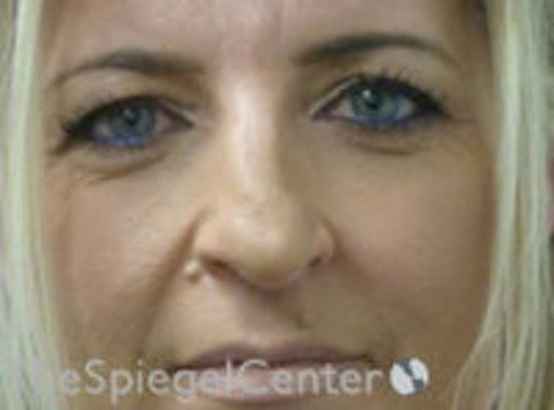 Rhinoplasty Before & After Gallery - Patient 157140031 - Image 3