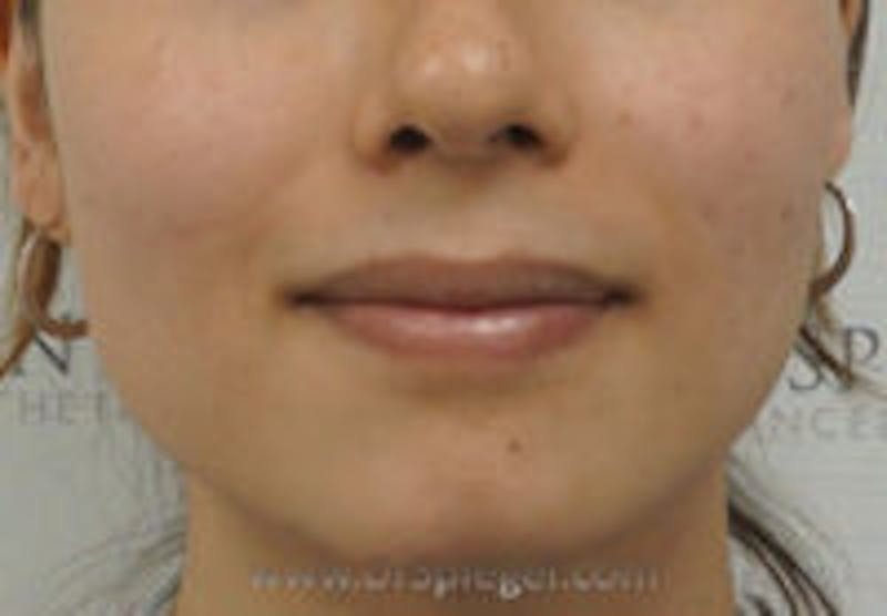 Mandible Contouring Before & After Gallery - Patient 157140030 - Image 1