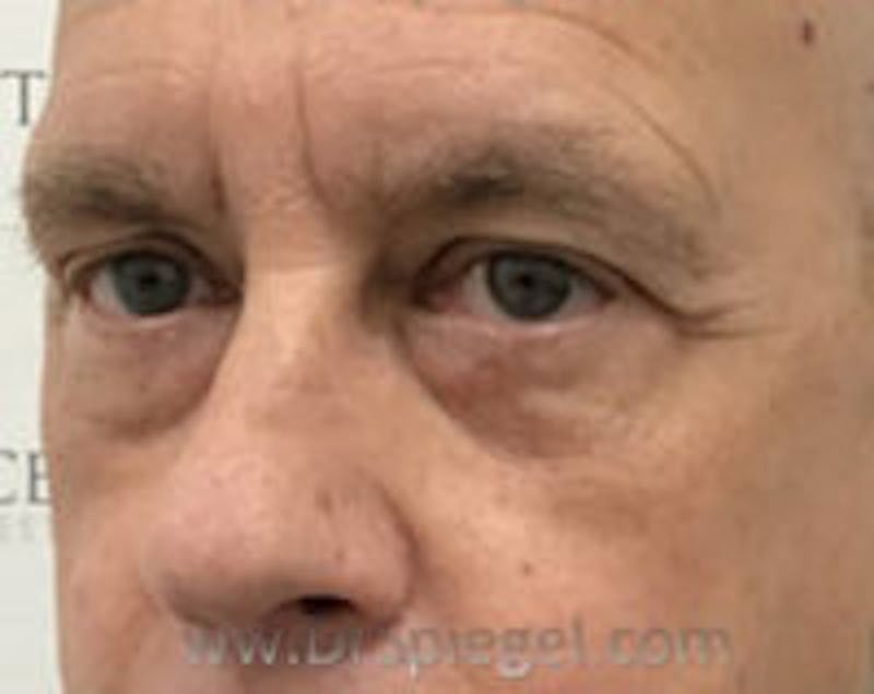 Blepharoplasty Before & After Gallery - Patient 157140029 - Image 4
