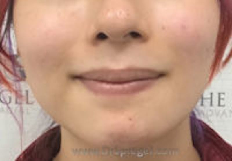 Mandible Contouring Before & After Gallery - Patient 157140030 - Image 2