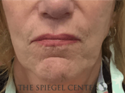 Lip Lift Before & After Gallery - Patient 157140037 - Image 1