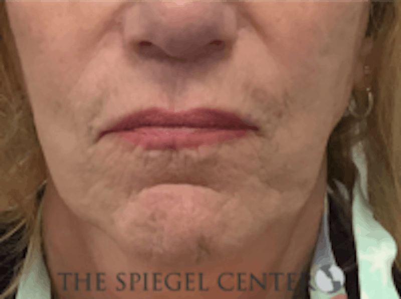 Lip Augmentation / Lip Implant / Lip Lift Before & After Gallery - Patient 157140037 - Image 1