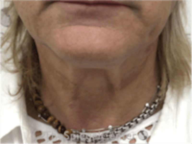 Neck Lift Before & After Gallery - Patient 157140038 - Image 3