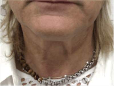Neck Lift Before & After Gallery - Patient 157140038 - Image 3