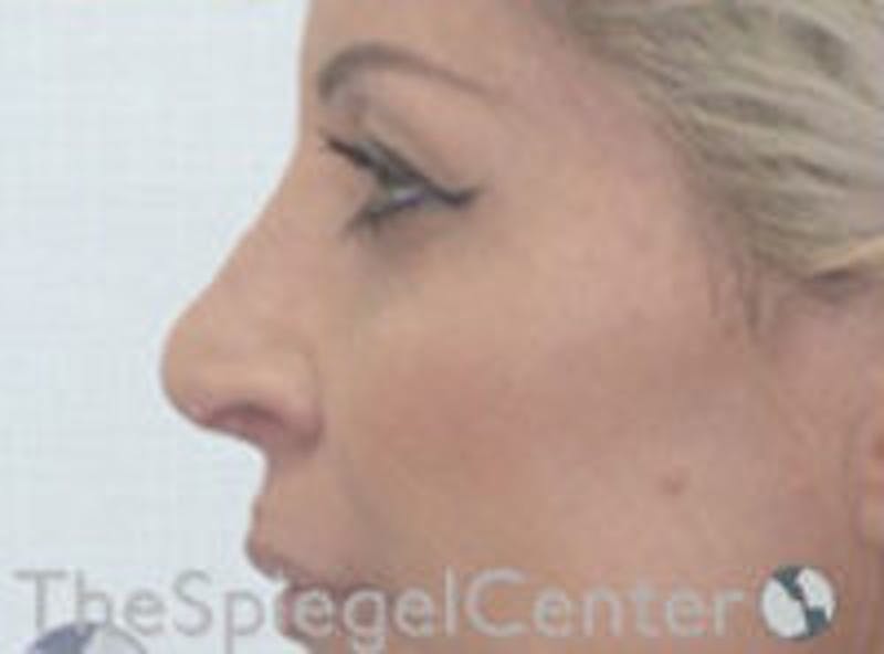 Rhinoplasty Before & After Gallery - Patient 157140031 - Image 2