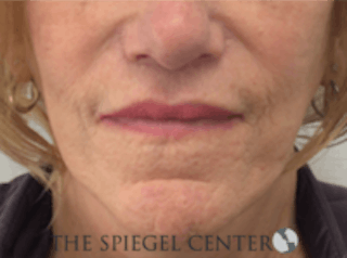 Lip Lift Before & After Gallery - Patient 157140037 - Image 2