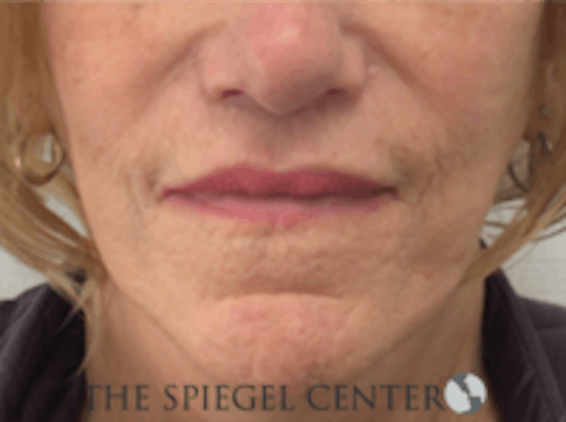 Lip Augmentation / Lip Implant / Lip Lift Before & After Gallery - Patient 157140037 - Image 2