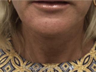 Neck Lift Before & After Gallery - Patient 157140038 - Image 4