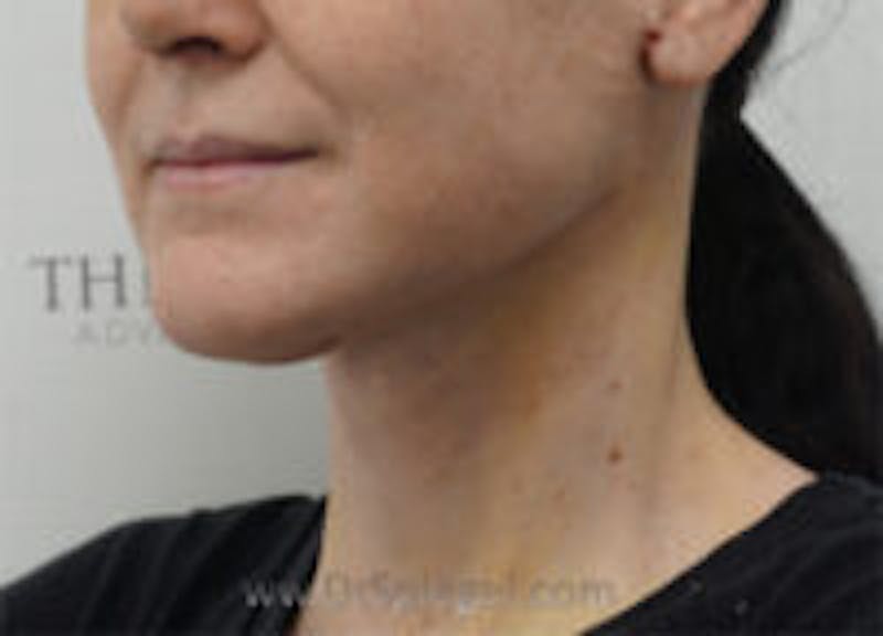 Mandible Contouring Before & After Gallery - Patient 157140035 - Image 1