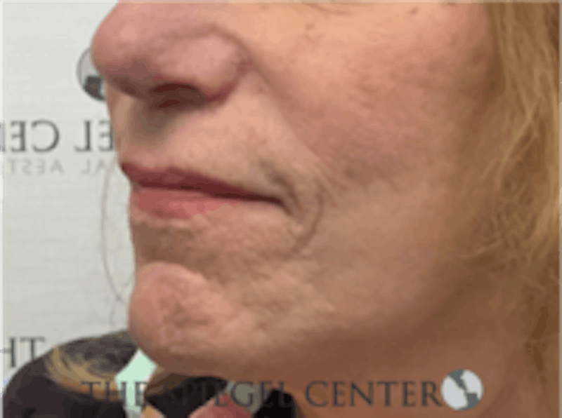 Lip Lift Before & After Gallery - Patient 157140037 - Image 3