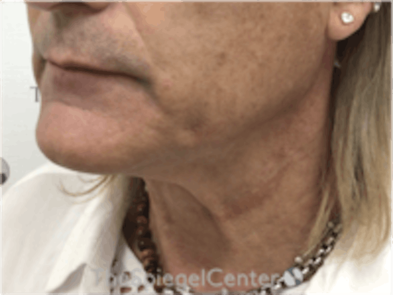 Neck Lift Before & After Gallery - Patient 157140038 - Image 1