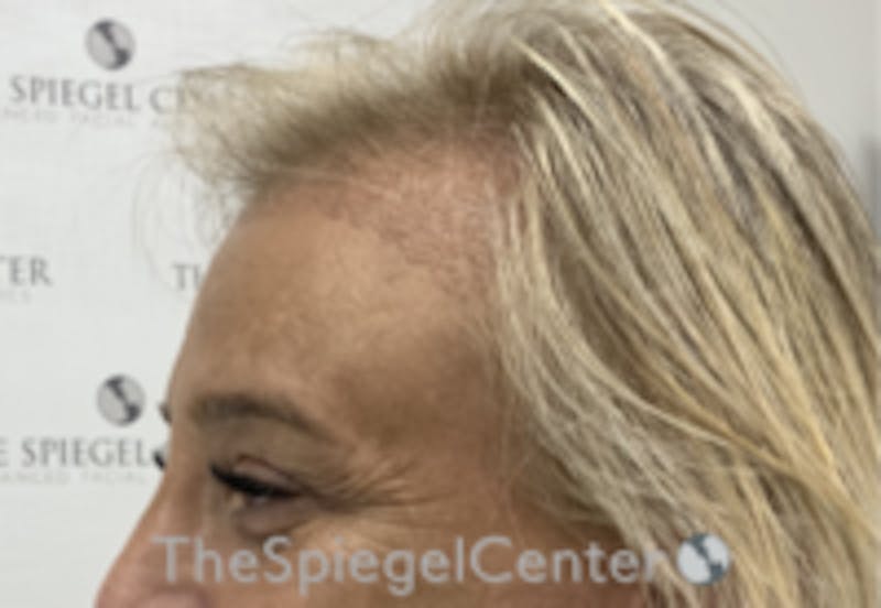 Forehead Contouring Before & After Gallery - Patient 157140036 - Image 4