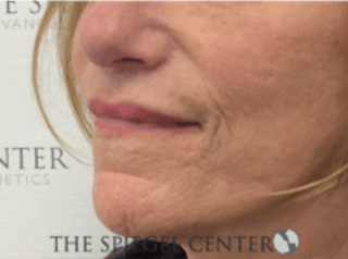 Lip Lift Before & After Gallery - Patient 157140037 - Image 4