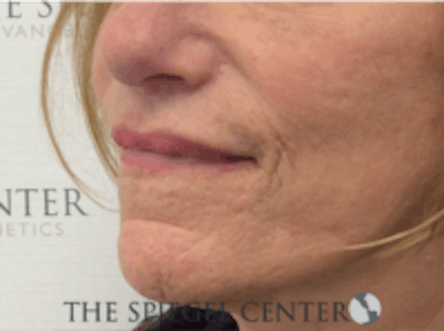 Lip Lift Before & After Gallery - Patient 157140037 - Image 4