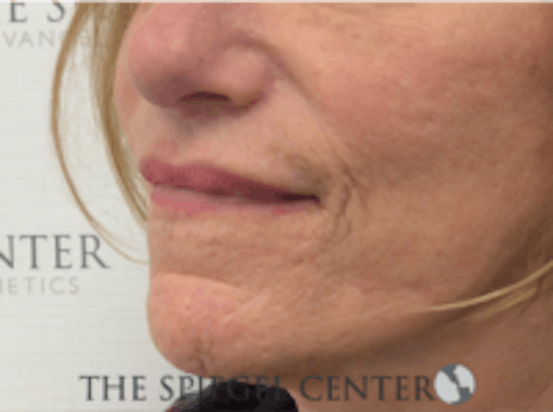 Lip Augmentation / Lip Implant / Lip Lift Before & After Gallery - Patient 157140037 - Image 4