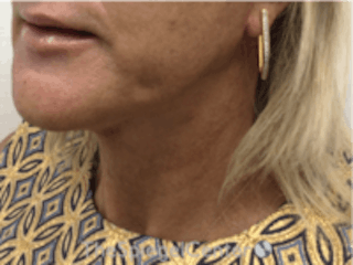 Neck Lift Before & After Gallery - Patient 157140038 - Image 2