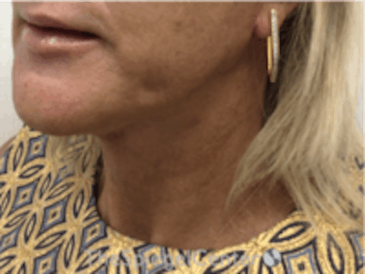 Neck Lift Before & After Gallery - Patient 157140038 - Image 2