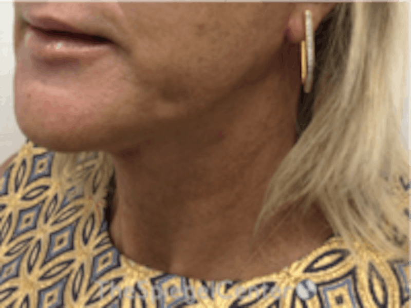 Neck Lift Before & After Gallery - Patient 157140038 - Image 2