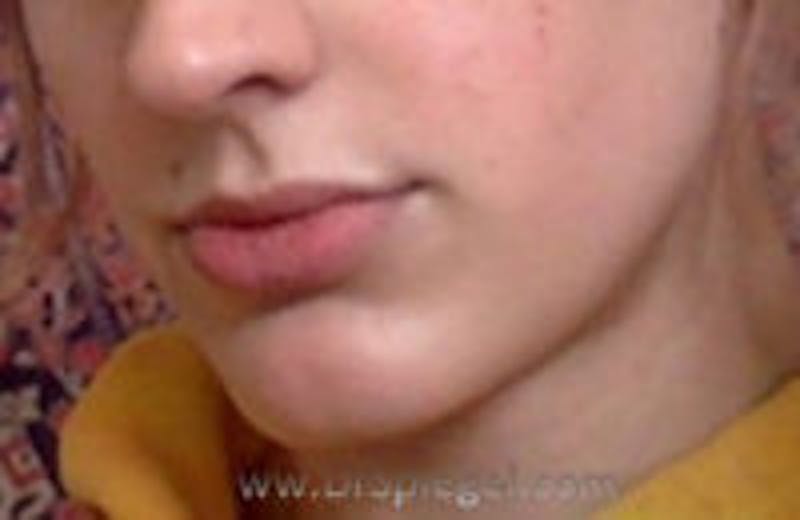 Mandible Contouring Before & After Gallery - Patient 157140041 - Image 1