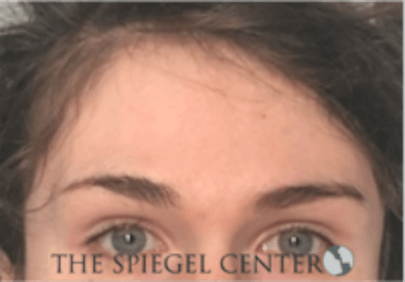 Forehead Contouring Before & After Gallery - Patient 157140043 - Image 1