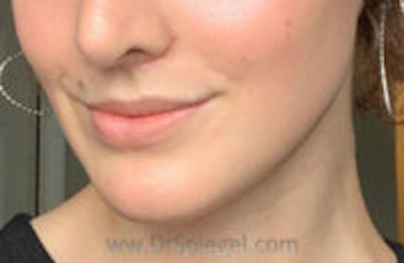 Mandible Contouring Before & After Gallery - Patient 157140041 - Image 2