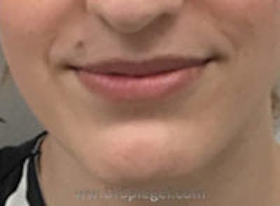 Lip Lift Before & After Gallery - Patient 157140044 - Image 1