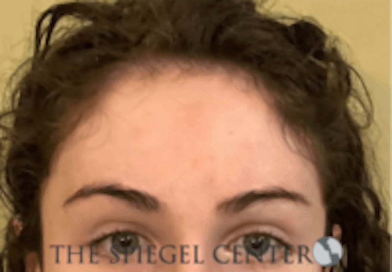 Forehead Contouring Before & After Gallery - Patient 157140043 - Image 2