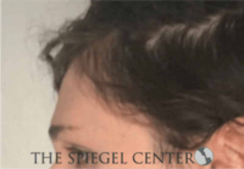 Forehead Contouring Before & After Gallery - Patient 157140043 - Image 3