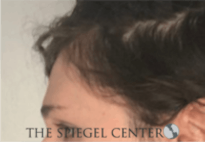 Forehead Contouring Before & After Gallery - Patient 157140043 - Image 3