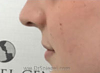 Lip Lift Before & After Gallery - Patient 157140044 - Image 3